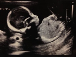 baby_ultrasound